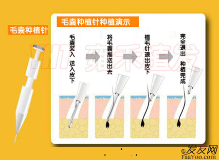 到底植发有没有副作用?