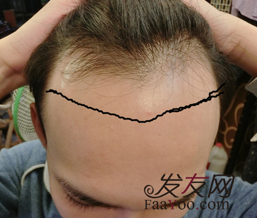 天生额头很高很宽怎么办,植发靠谱吗