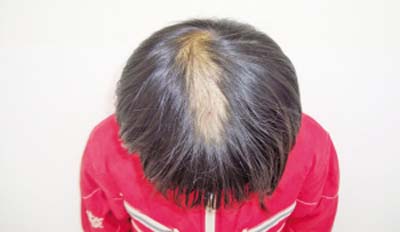 治疗斑秃的方法有什么?