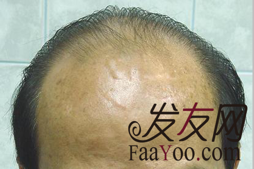 治疗男性脱发的方法都有什么呢?