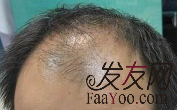 脱发都有哪些方法治疗呢? 