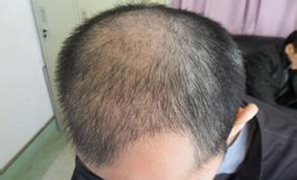 脱发治疗的方法有哪些呢?　