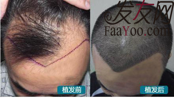 植发不可怕 只是你不了解?