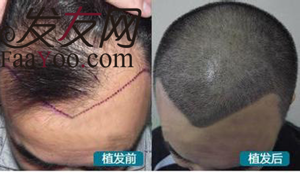 植发后头发多久可以长出来呢?