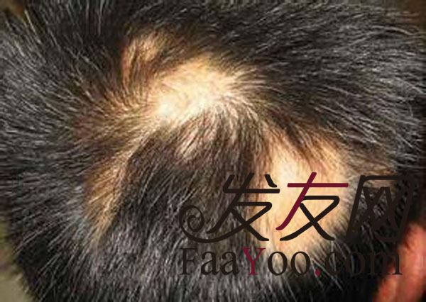 植发有哪些人不适合做?