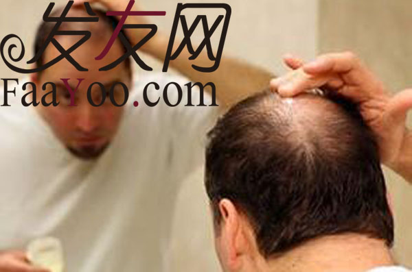 治疗男性脱发有效的方法？