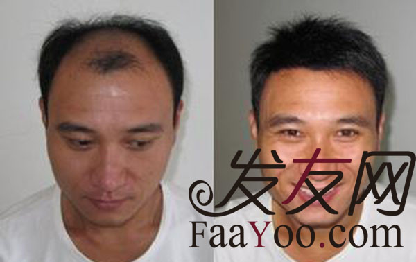 脱发治疗都有什么方法?