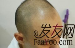 深圳雍禾植发手术记录