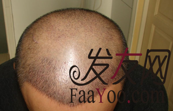 我的植发记录