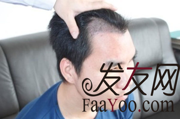 植发手术的时候没有理发,大家看看还可以吧?