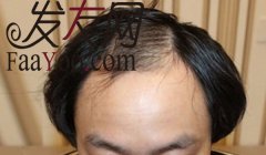 在雍禾刚做完手术，各位看看如何？