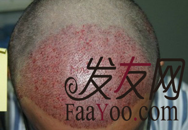 上海411医院4月19号免费试种走起!