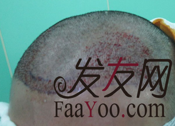 脱发五年后,重返京城赶赴瑞丽诗做植发
