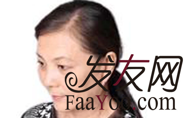 女性治疗脱发的方法?