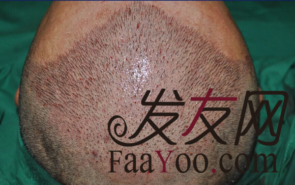 南京科发源2300单位! 植发后找回失去的自信