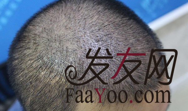 伊美尔瑞丽诗植发,效果我很满意!