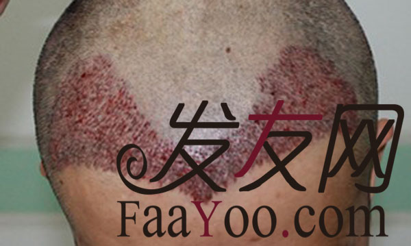 额角发际线种植2500单位