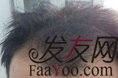 西安科发源植发，11.10号，2740株