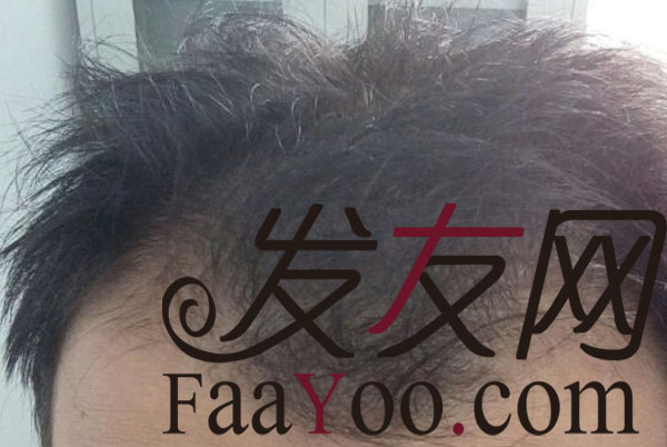 西安科发源植发,11.10号,2740株