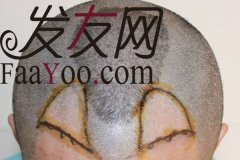 一个北漂的植发经历，为了你我愿意改变