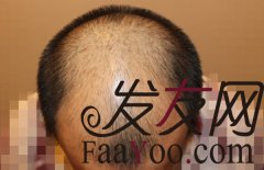 男人光头不是罪----成都科发源FUE+PTT