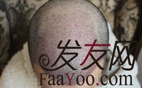 男人光头不是罪----成都科发源FUE+PTT　