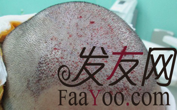 大叔变帅哥,杭州瑞丽诗植发2500