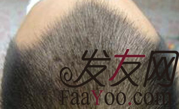 植发,头发你终于回到了我的身边