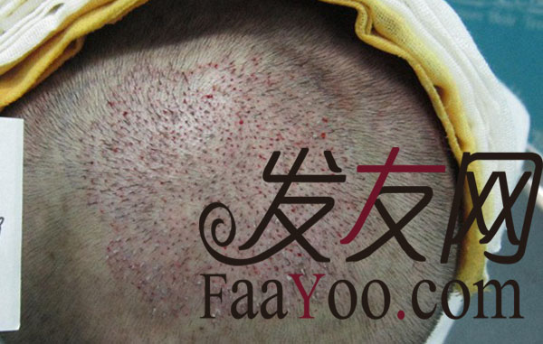青岛瑞丽诗植完的效果这么完美 祝福我吧