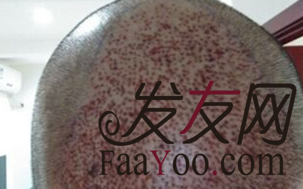 上海411植发医院3510单位,前额发际线修复+头顶加密