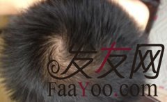 治疗脱发的方法都有什么呢？