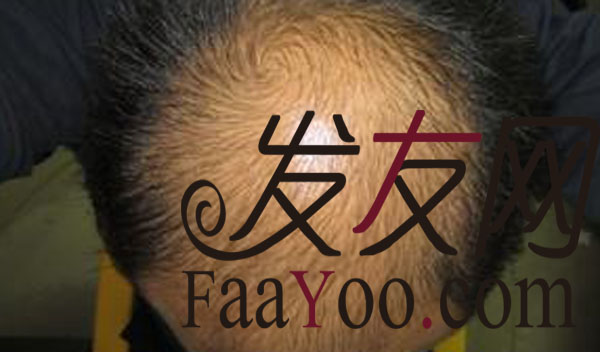 脱发都有哪些治疗的方法?