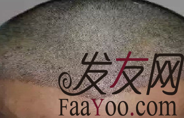 南宁雍禾植发,让我回归自信的我!赞一个!!