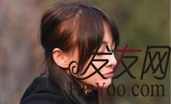 脱发治疗较好的方法有哪些?