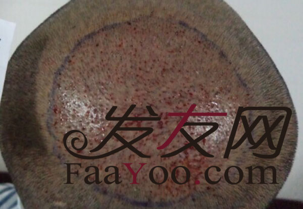 碧莲盛植发旋已经10个月了,看看效果吧?