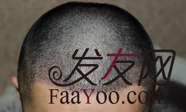我的故事讲给你听 植发FUE+PTT 1615单位