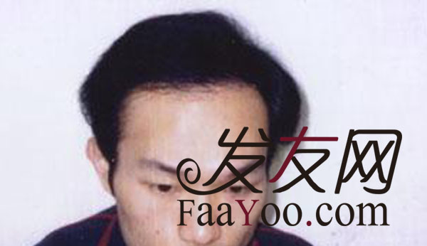 治疗男性脱发的方法?