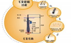 植发手术分为那几步？