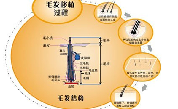 做植发都有哪些步骤呢？　