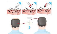 植发手术可不可以相信？