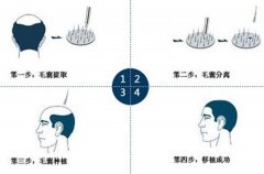 植发的步骤都有什么？