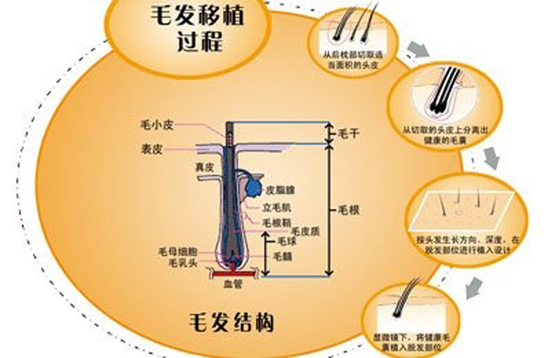 植发都应该注意哪些事情?