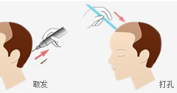 植发医院应该如何来判断?