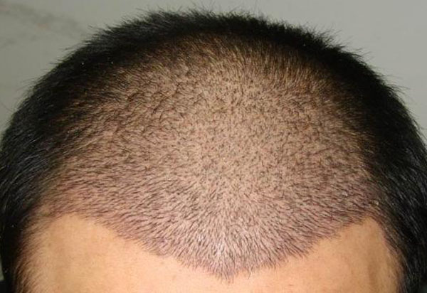 植发是否安全?