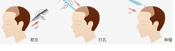 植发医院应该怎么选择?