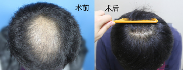 植发到底怎么样?