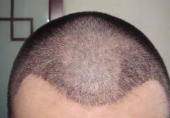 脱发植发有没有伤害？