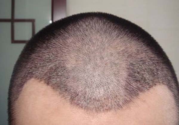 脱发植发有没有伤害？　