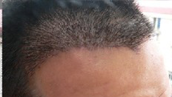 植发都有哪些危害？　