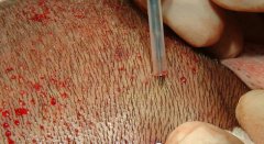 植发那个季节好？